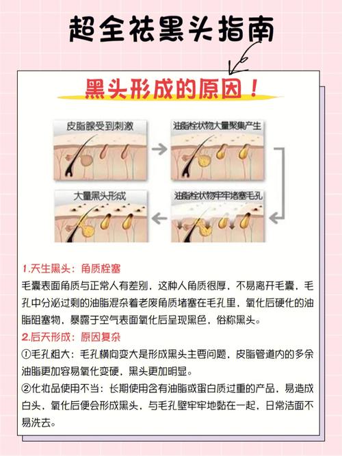 去除黑头美容院小气泡不靠谱!做对这2件事:和草莓鼻Say拜拜(黑頭美容院皮膚)