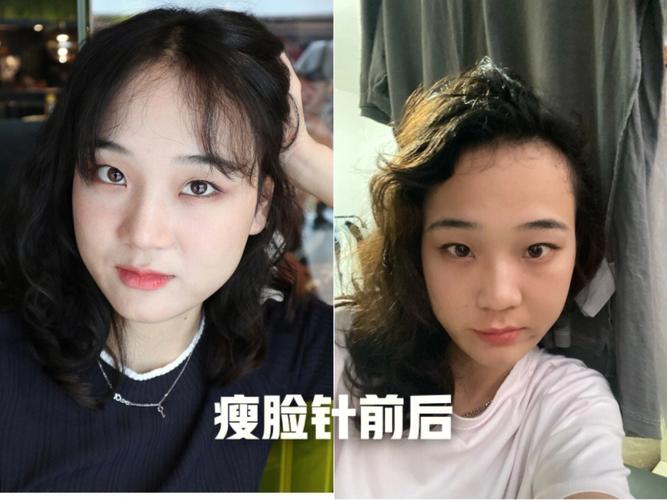 变白!瘦脸!这些在脸上打的针_真有那么神奇?(變白尿酸瘦臉)