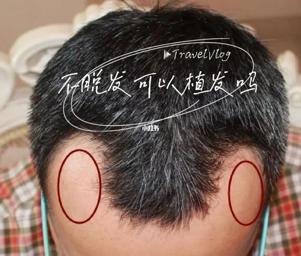 一个毛囊20元_被“植发”吓到的可不止高价……(植發毛囊脫發)