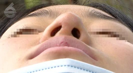 隆鼻花了一万多_两次手术仍觉得有点歪_这事怎么办?(隆鼻手術兩次)