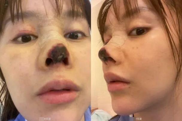 女演员整形失败鼻尖坏死_涉事机构如今仍有大量隆鼻宣传照(事機整形隆鼻)