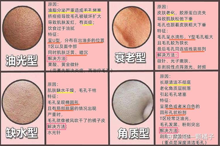 肌肤毛孔空隙的三种不同类型_女性都想了解的护肤小知识(毛孔孔隙不同類型)