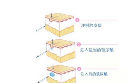 如何保持面部年轻化(面部年輕化註射)