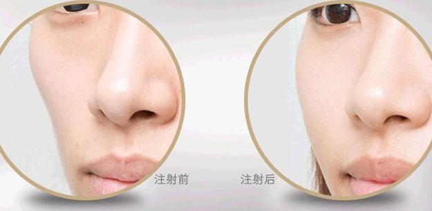 自体脂肪填充面部_Get这几点变美道路一片坦途(脂肪面部填充)