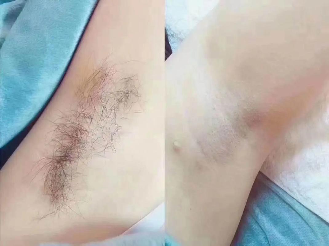 【秒懂知识库】家用脱毛仪会让皮肤变黑?(脫毛皮膚變黑)
