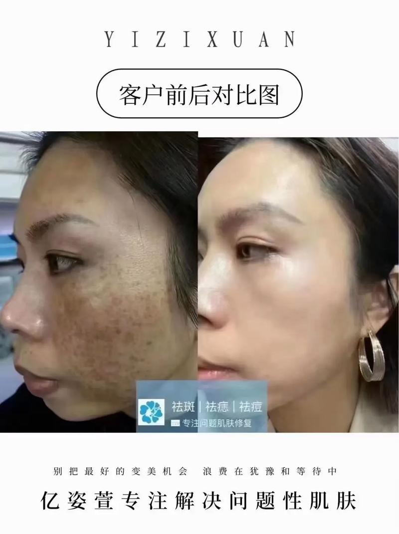 网购祛斑祛痘产品_无效退款攻略!(女士老師退款)