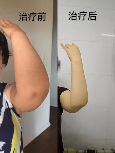 女子乳腺癌术后手臂肿得比大腿还粗 改良手术让肿胀20年的巨臂恢复正常(水腫淋巴上肢)