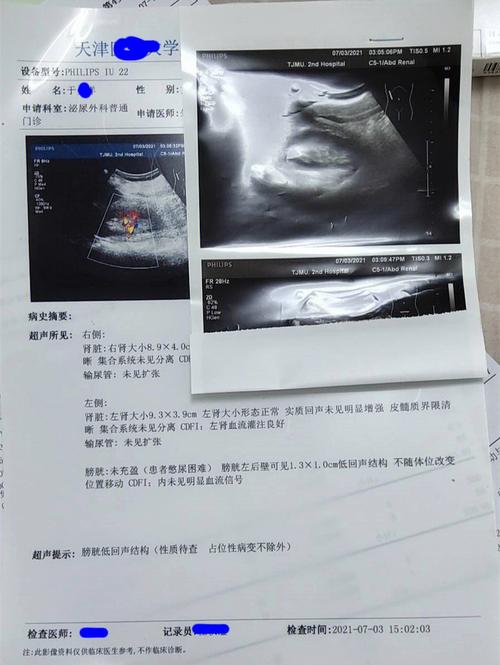 取环致宫腔化脓性感染引发腰椎间盘炎一例报道并文献复习(感染椎間盤患者)